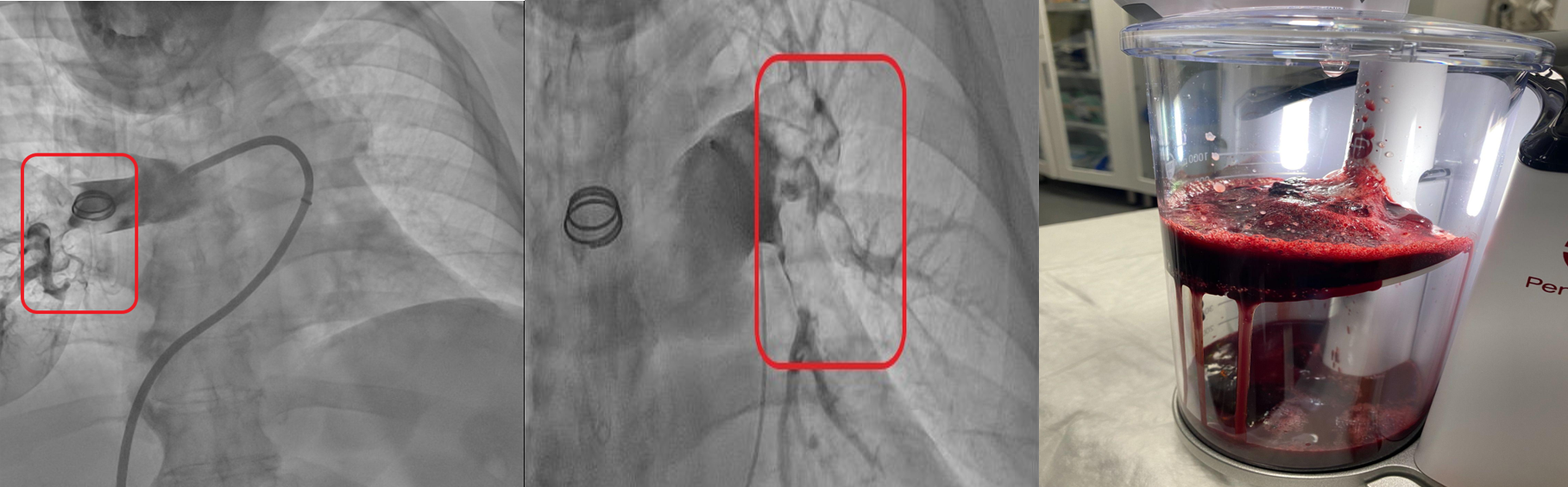 Imagen 2. Tromboextracción por aspiración. Izquierda: árbol pulmonar izquierdo, imagen central: árbol pulmonar derecho. Las áreas delimitadas dentro del cuadro rojo son el material trombogénico, manifestado como defectos de llenado en las arterias pulmonares que interrumpen el flujo normal del contraste durante el estudio. Imagen de la derecha: contenedor para depósito del material trombótico y hemático aspirado del dispositivo Penumbra. Fuente: elaboración propia. Imagen 2. Tromboextracción por aspiración. Izquierda: árbol pulmonar izquierdo, imagen central: árbol pulmonar derecho. Las áreas delimitadas dentro del cuadro rojo son el material trombogénico, manifestado como defectos de llenado en las arterias pulmonares que interrumpen el flujo normal del contraste durante el estudio. Imagen de la derecha: contenedor para depósito del material trombótico y hemático aspirado del dispositivo Penumbra. Fuente: elaboración propia.