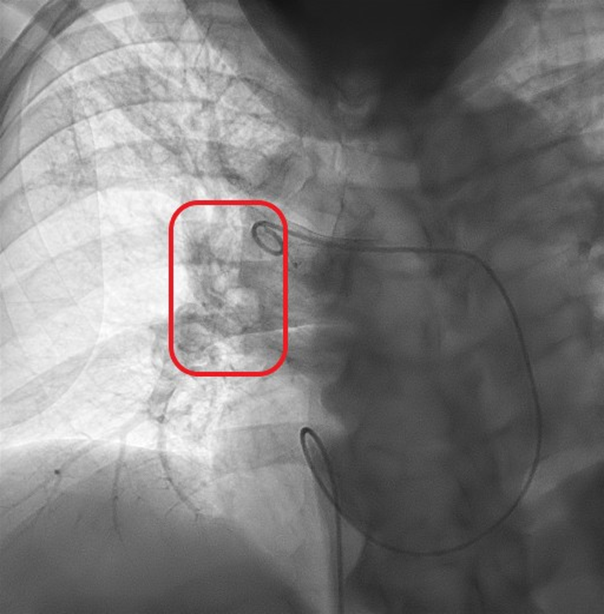 Imagen 3. Trombólisis pulmonar dirigida por catéter de la arteria pulmonar derecha. Fuente: elaboración propia. Imagen 3. Trombólisis pulmonar dirigida por catéter de la arteria pulmonar derecha. Fuente: elaboración propia.