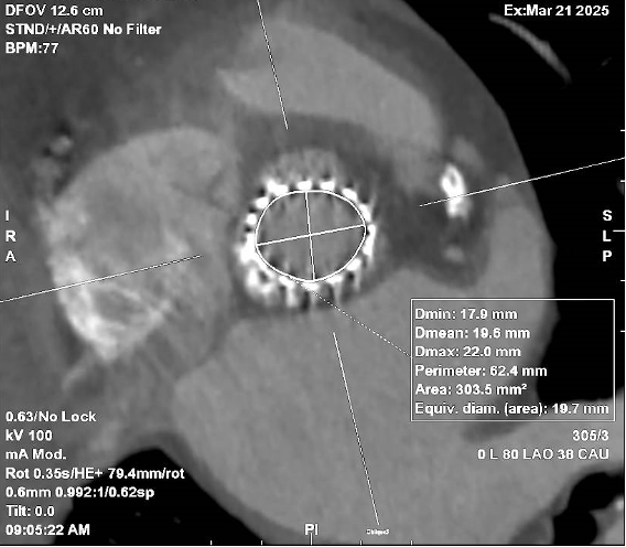 Figura 2. Angio-TC cardíaca en corte axial mostrando un anillo aórtico con prótesis valvular previamente implantada. Se observan las medidas del orificio protésico (Dmin: 17.9 mm; Dmax: 22.0 mm; área: 303.5 mm²; diámetro equivalente: 19.7 mm) y la configuración de los elementos metálicos radiales de la válvula en su ubicación anatómica.