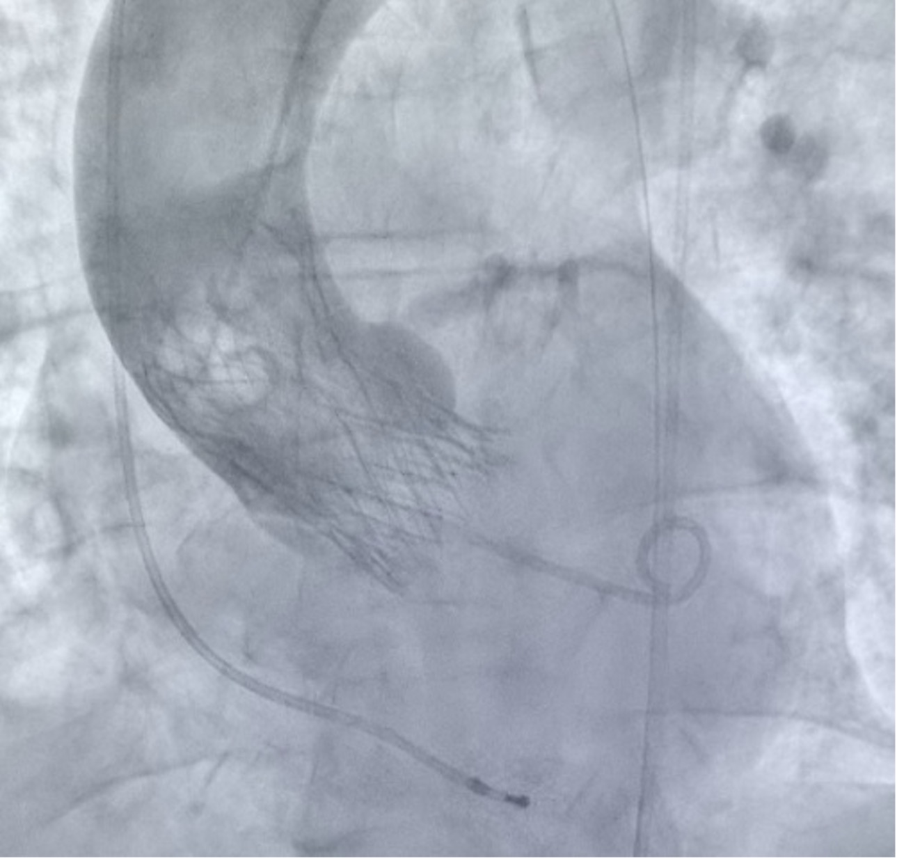Figura 3. Resultado angiográfico final tras implante exitoso de TAVI valve-in-valve, con adecuada expansión y posicionamiento de la prótesis dentro de la bioprótesis previa, sin insuficiencia aórtica residual significativa ni complicaciones angiográficas inmediatas.