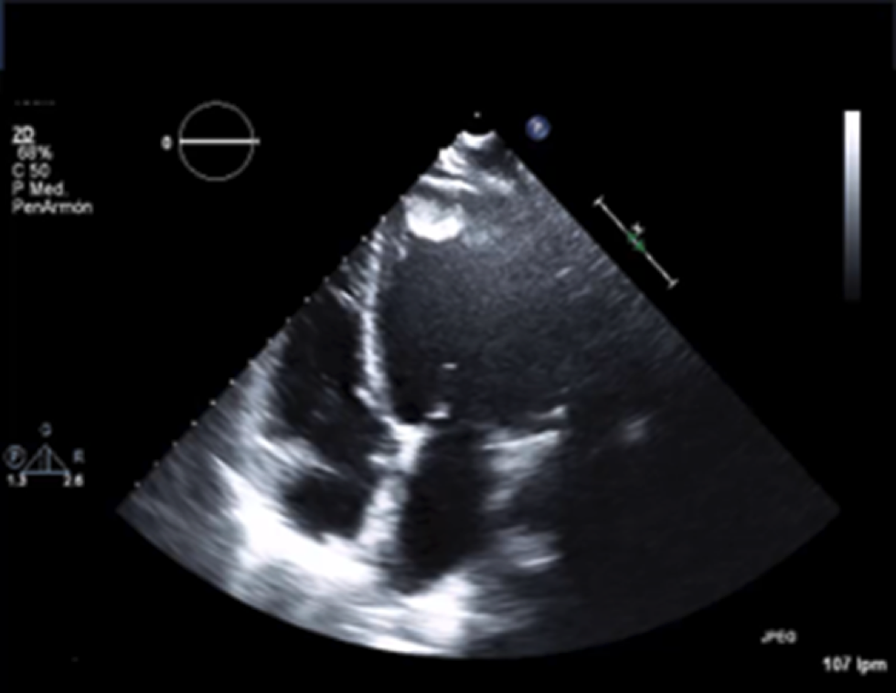 Figura 1. Ecocardiograma realizado en urgencias. Muestra
				la dilatación del ventrículo izquierdo así como trombo intraventricular.