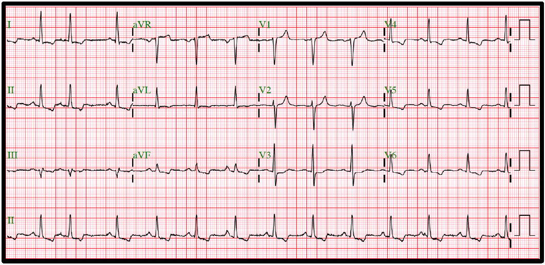 Figura 1. Electrocardiograma. Figura 1. Electrocardiograma.