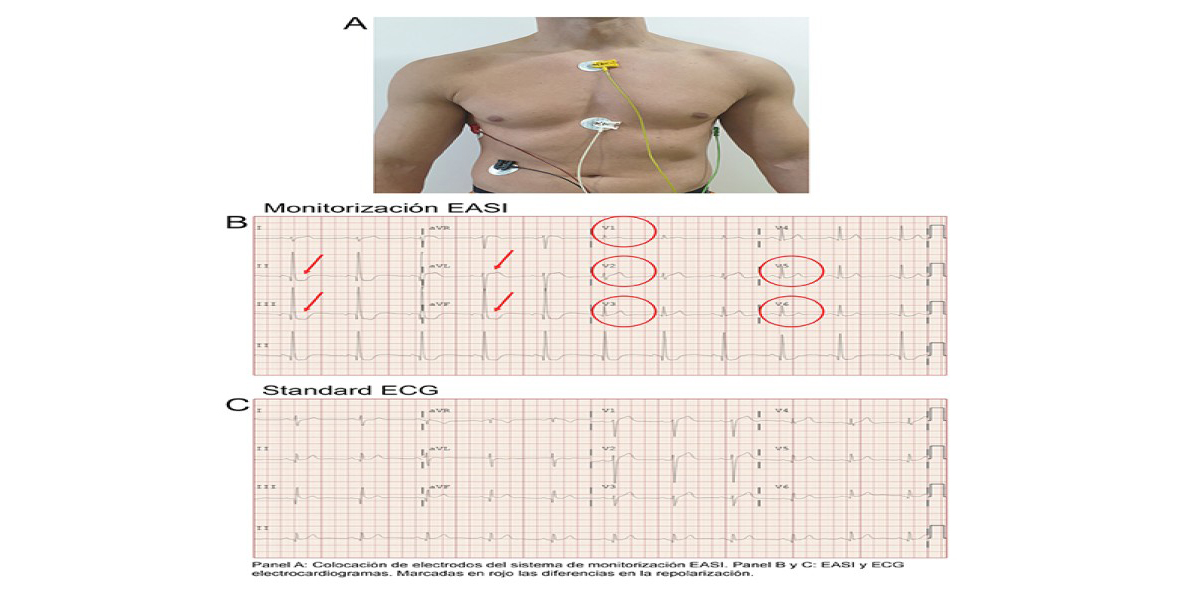 Colocación de electrodos en monitorización EASI. EASI y ECG electrocardiogramas