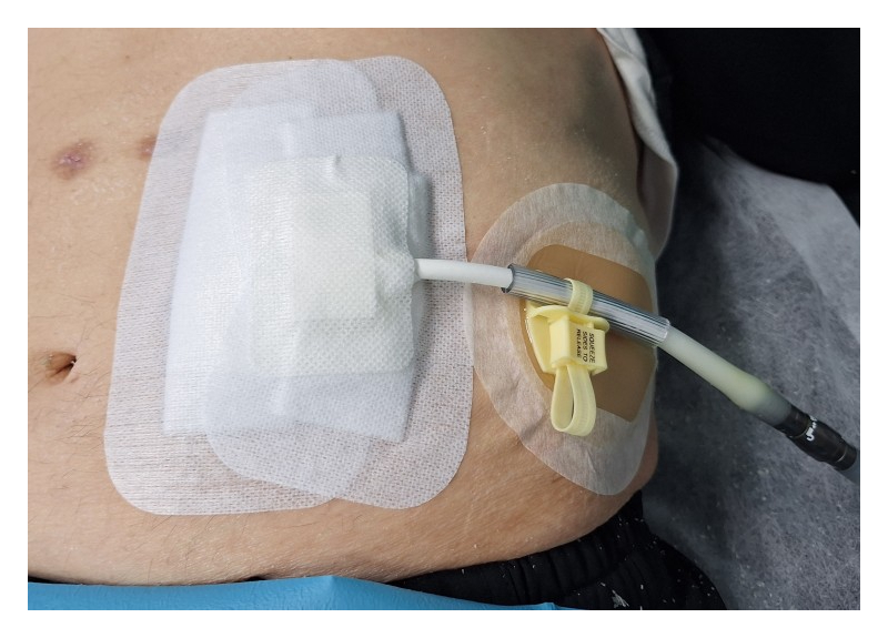 Cura en paciente con asistencia ventricular de larga duración