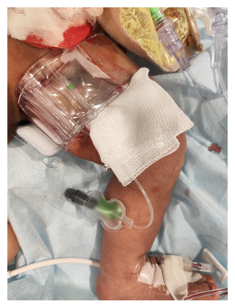 Pulsera hemostática radial en zona de punción femoral