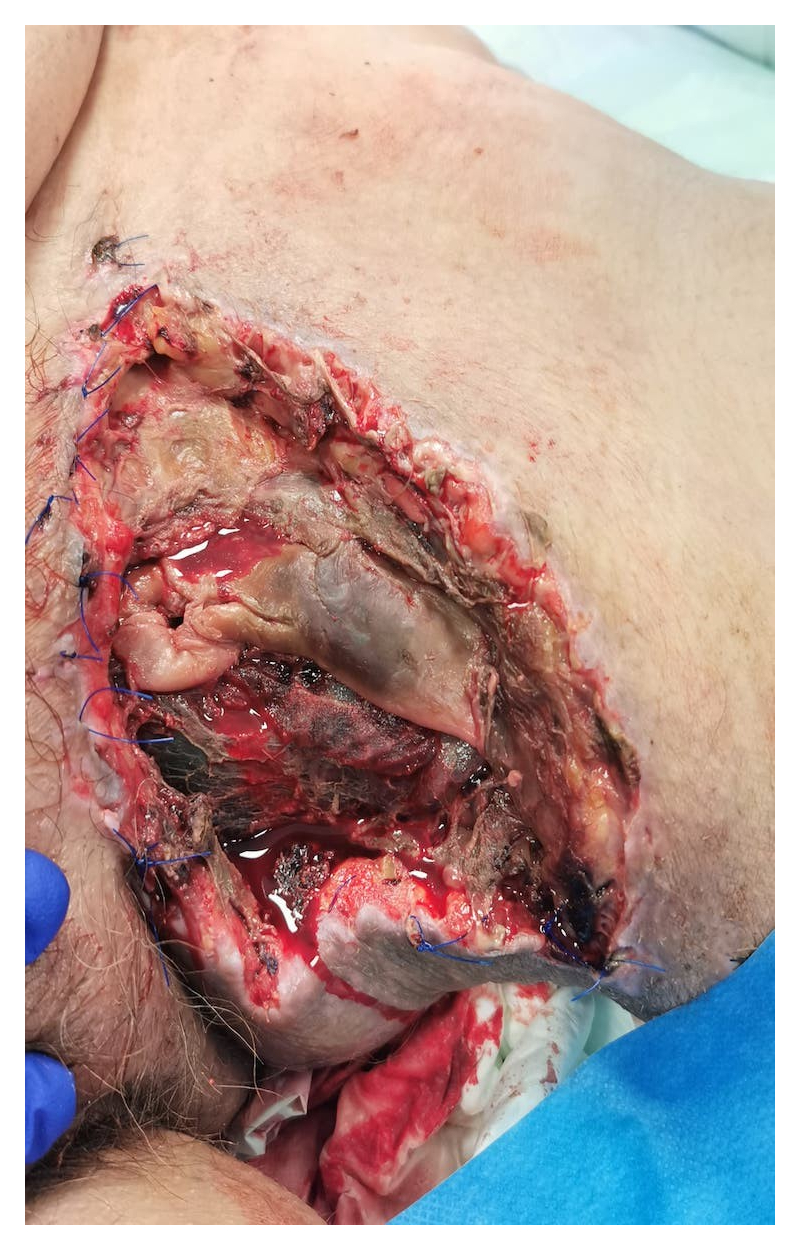 Dehiscencia herida quirúrgica hematoma inguinal